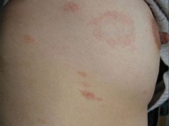 玫瑰糠疹的病因是什么2015-02-01