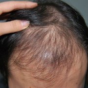 脱发的预防方法有哪些2015-02-01