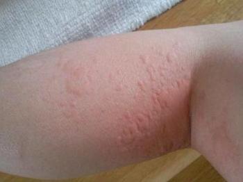 引起皮肤瘙痒的病因是什么呢